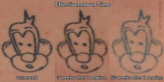 places to remove tattoos dallas Fade Fast Laser Tattoo Removal