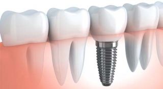 dental implantology courses dallas Dallas Dental Implant Center